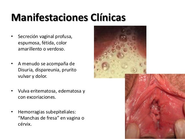 Enfermedades Venerias En La Vulva Enfermedades Venerias En La Vulva